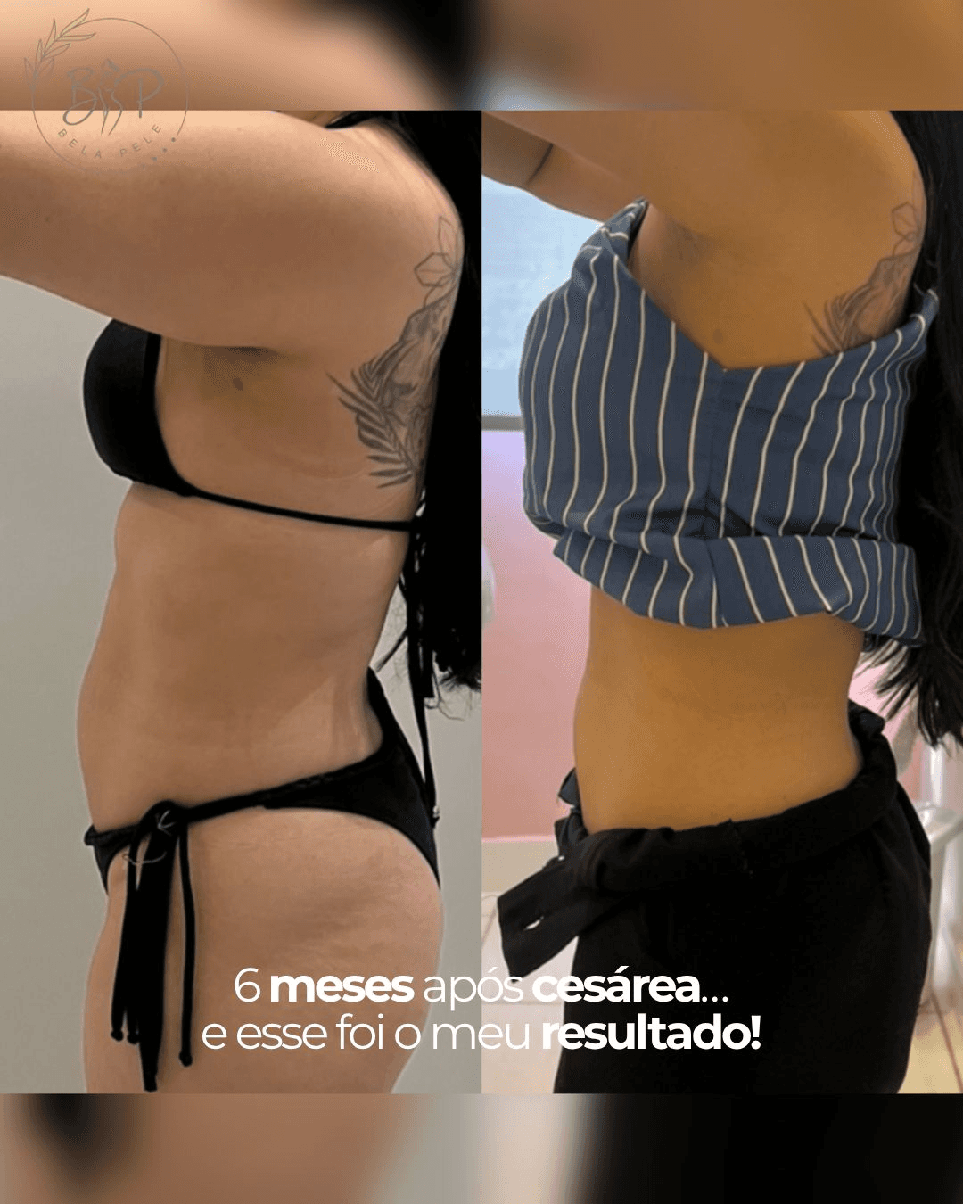tratamento-gordura-localizada-barreiro-bh